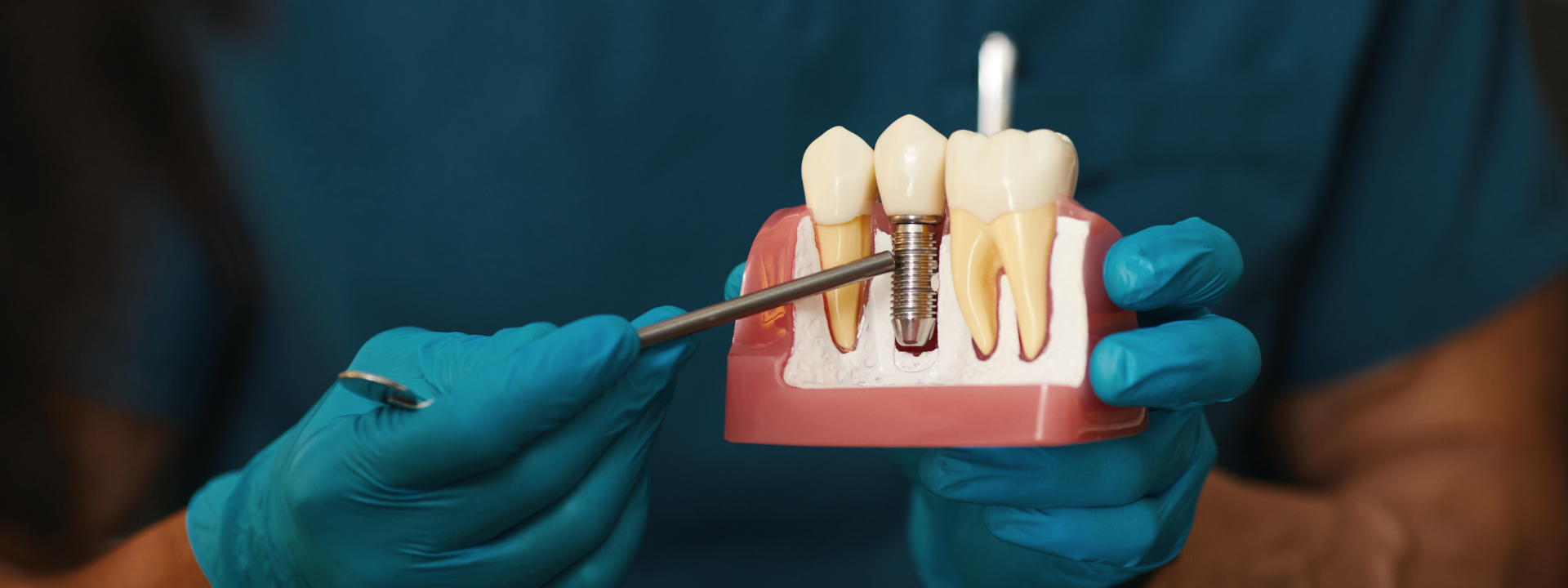 Dental Implants in Coquitlam, BC