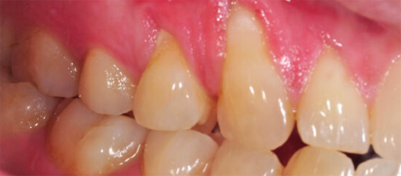 Periodontic3a_Before.png